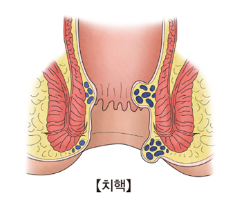 치핵