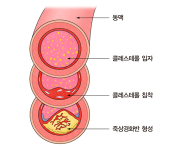 죽상경화증