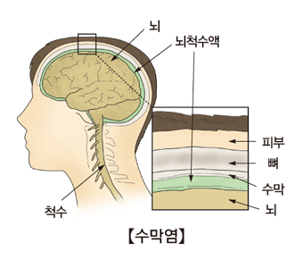 결핵성 수막염