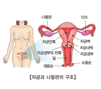 여성 난임
